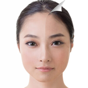 woman before and after a chemical peel