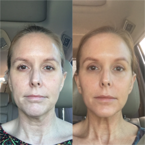 before and after picture of woman getting facials